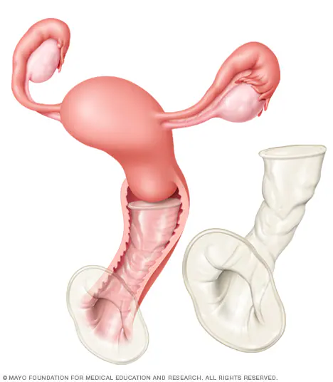 <p>vaginal sheath made of nitrile, a nonlatex synthetic rubber with flexible rings on both ends that is pre-lubricated with a spermicdie </p>