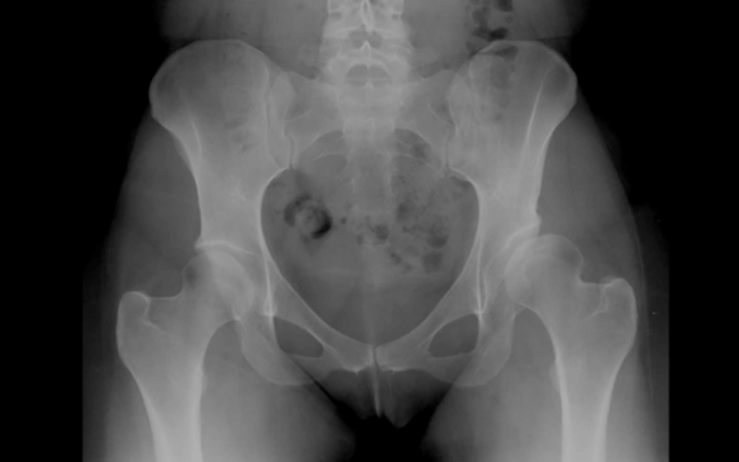 <p>limb = LONGER</p><p>shear forces = LESS</p><p>moment arm of glut med = SHORTER</p><p>joint reaction forces = HIGHER</p><p>joint congruency = DECREASED</p><p>joint stability = LOWER</p><p>articular cartilage pressure = HIGHER</p>