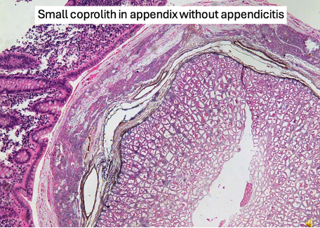 <p><span>Epithelium is intact and no inflammatory cells intraepithelial</span></p>