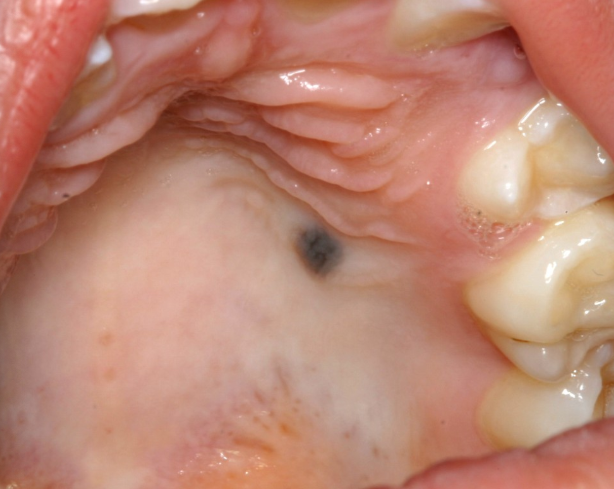 <p>Case 9. A 45-year-old female with a small well-demarcated brown macule on the hard palate was discovered during a dental examination. 9a. What would be the differential diagnosis?</p><p><span><span>Melanocytic nevus and melanotic macule</span></span></p><p><span><span>Melanoma and amalgam tattoo</span></span></p><p><span><span>Amalgam tattoo and blue nevus</span></span></p><p><span><span>Melanoma and melanotic macule</span></span></p>