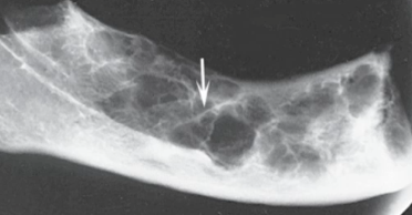 <p>well-defined RL multilocular lesion in posterior mandible  with characteristic “tennis racket” septa </p>