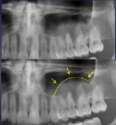 <ol><li><p>relative<strong> radiopacity</strong> on floor of sinus </p></li><li><p>well-defined, <strong>not corticated</strong> </p></li><li><p><strong>dome-shaped</strong> </p></li></ol><p></p>