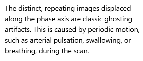 <p>A. Motion/ghosting in the phase direction</p>