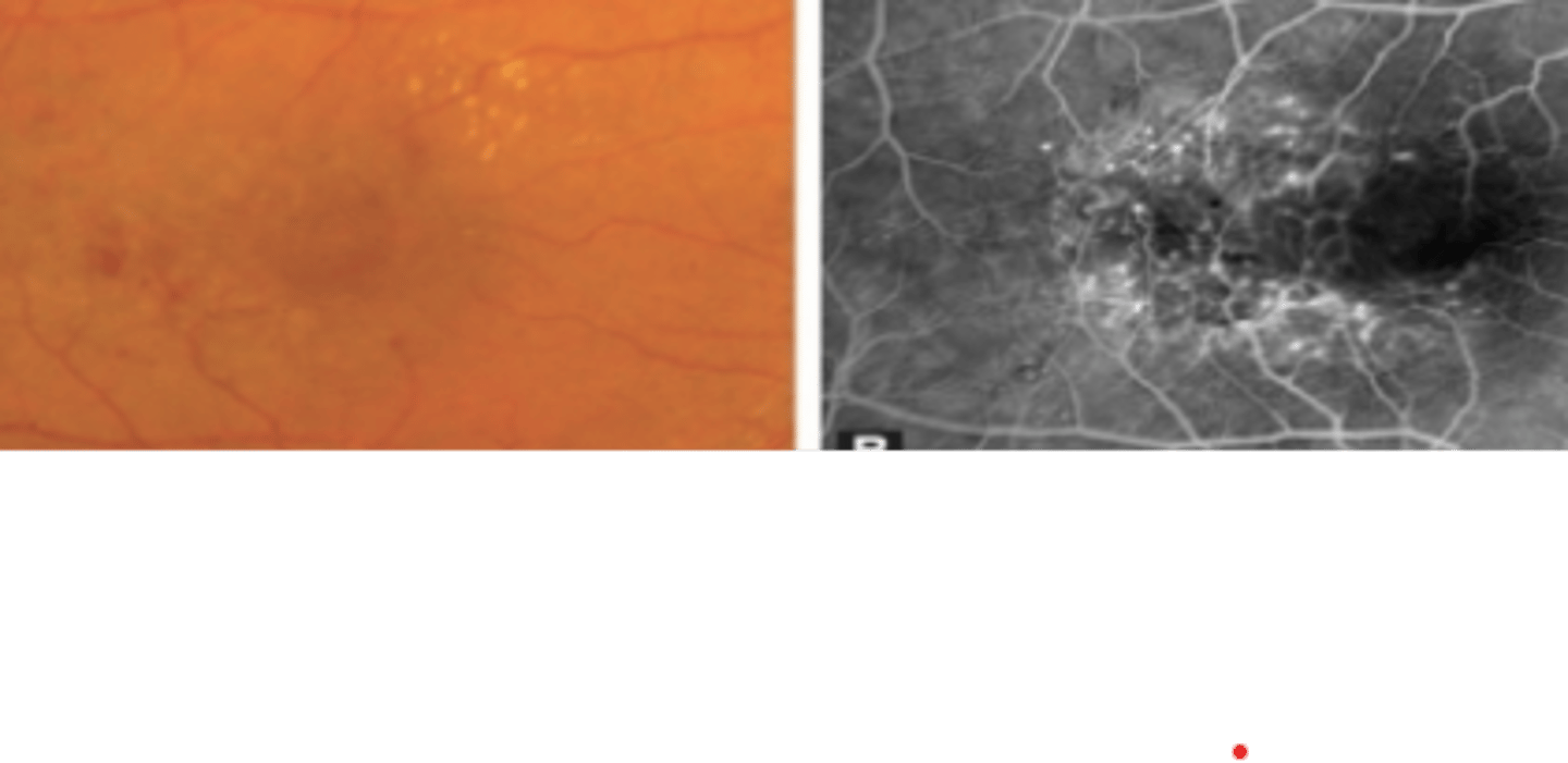 <p>congenital group of IJFTs that are unilateral with easily visible telangiectasias occurring primarily in males 40yo and causing visual loss due to macular edema. Degree of vision loss is variable.</p>