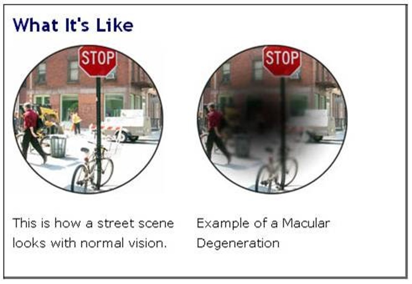 <p>a condition in which the macula degenerates, gradually causing central vision loss</p>