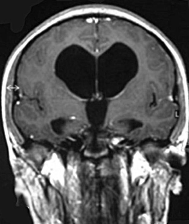 <p>PI: a 24 y/o man becomes acutely ill and presents to the ER in a depressed level of consciousness. MRI of his brain reveals enlarged ventricles as shown here, the fourth ventricle appears normal.</p><ol><li><p>right interventricular foramen</p></li><li><p>left interventricular foramen</p></li><li><p>both interventricular foramina</p></li><li><p>cerebral aqueduct</p></li><li><p>foramen of magendie</p></li><li><p>both foramen of luschka</p></li></ol>