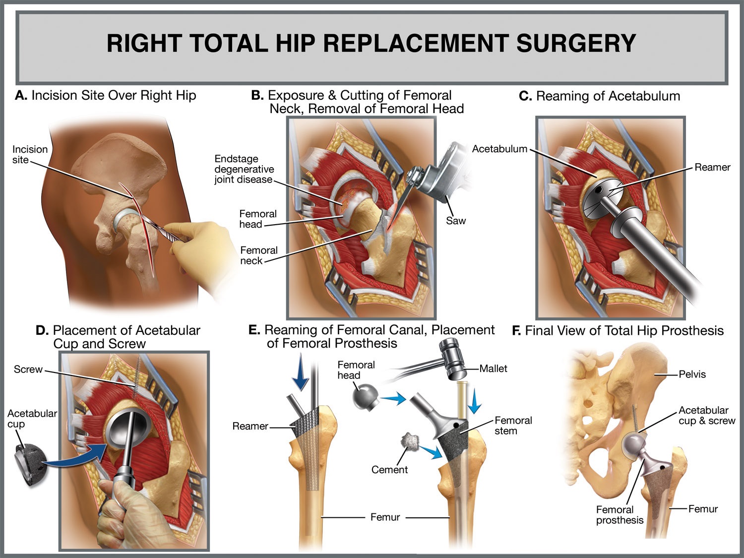 <p>total hip arthroplasty procedure</p>