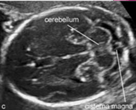 <p>cisterna magna and nuchal fold</p>