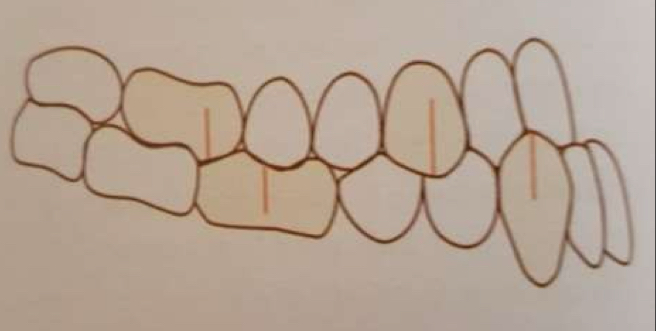 <p>1st lower molar Buccal groove occludes <strong>mesially</strong> to 1st upper molar mesiobuccal </p>
