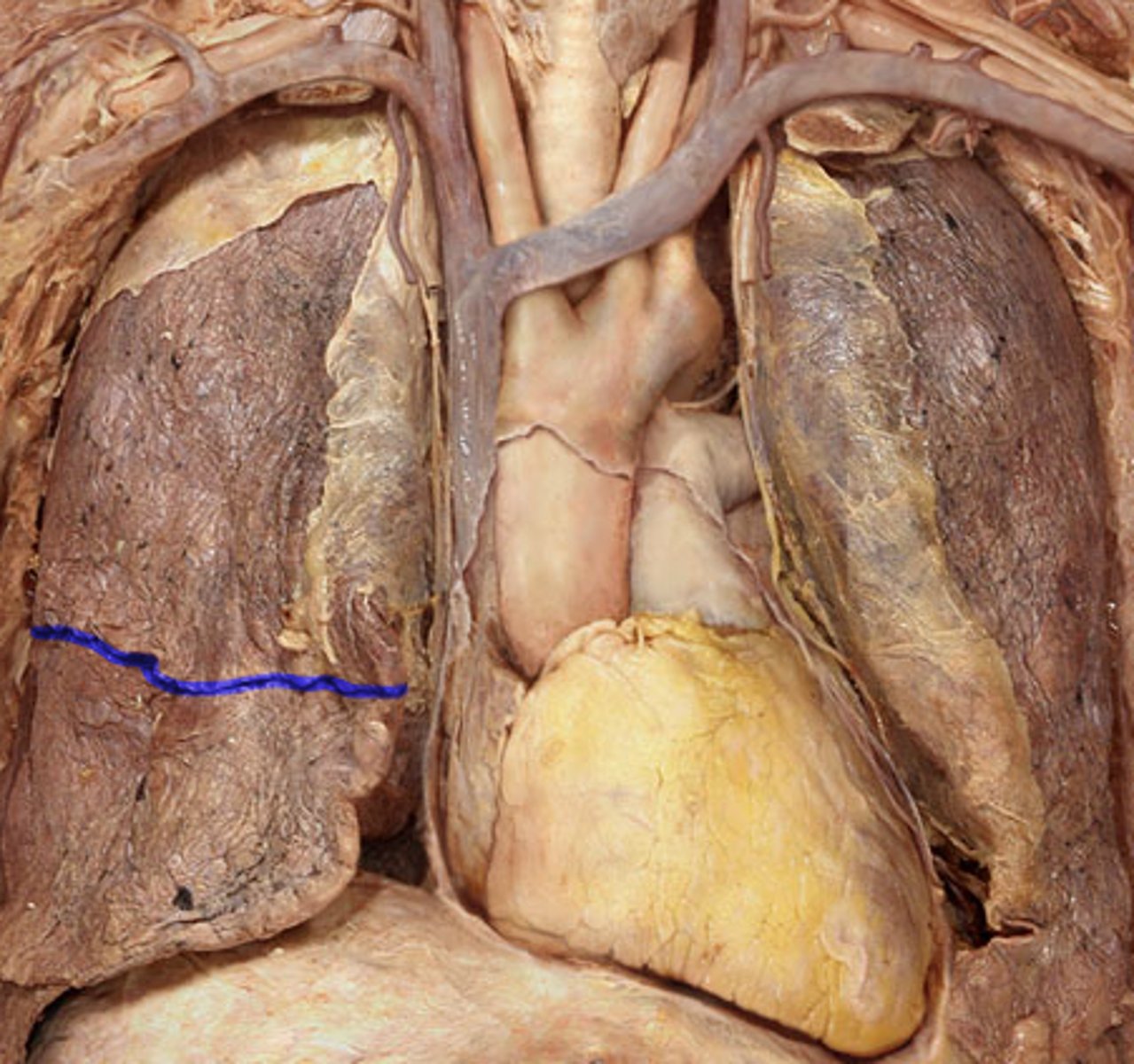 <p>between superior and middle lobes</p>