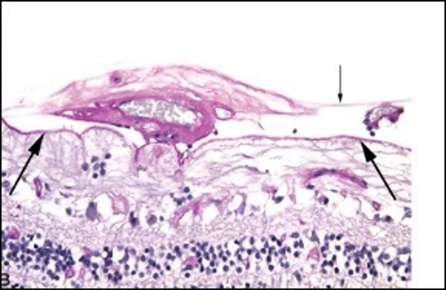 <p>Describe Proliferative Diabetic Retinopathy</p>