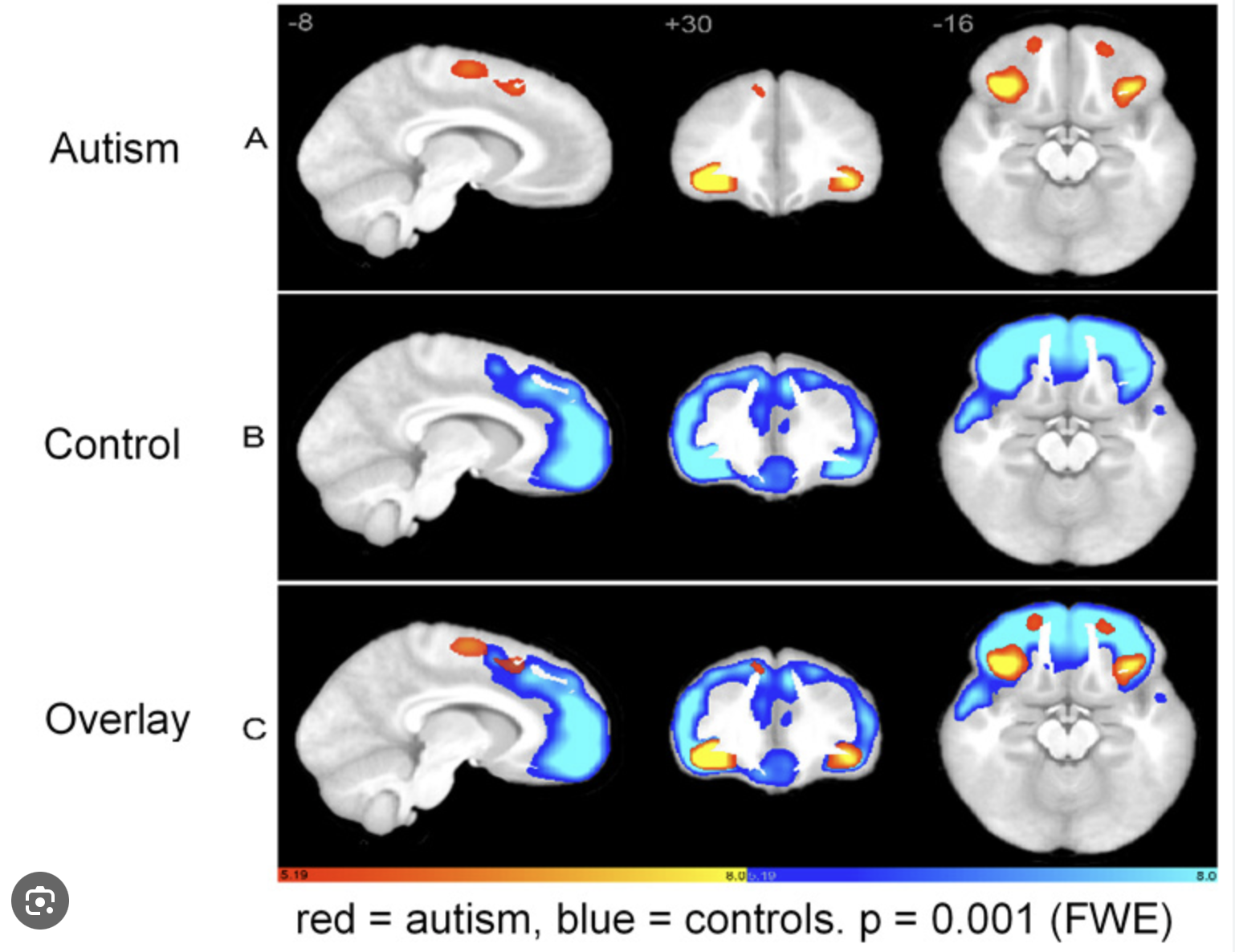 <ul><li><p>cerebellum</p></li><li><p>striatum</p></li><li><p>amygdala</p></li><li><p>hippocampus</p></li><li><p>insular cortex</p></li></ul><p>They have reduced activation in social cognition areas (PFC, tmpoeral-parietal junction, fusiform face area)</p><p>What </p>