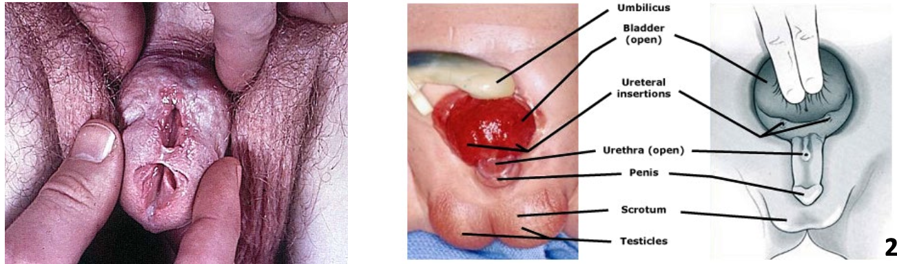 <p>Epispadias Etiology and pathogenesis</p>