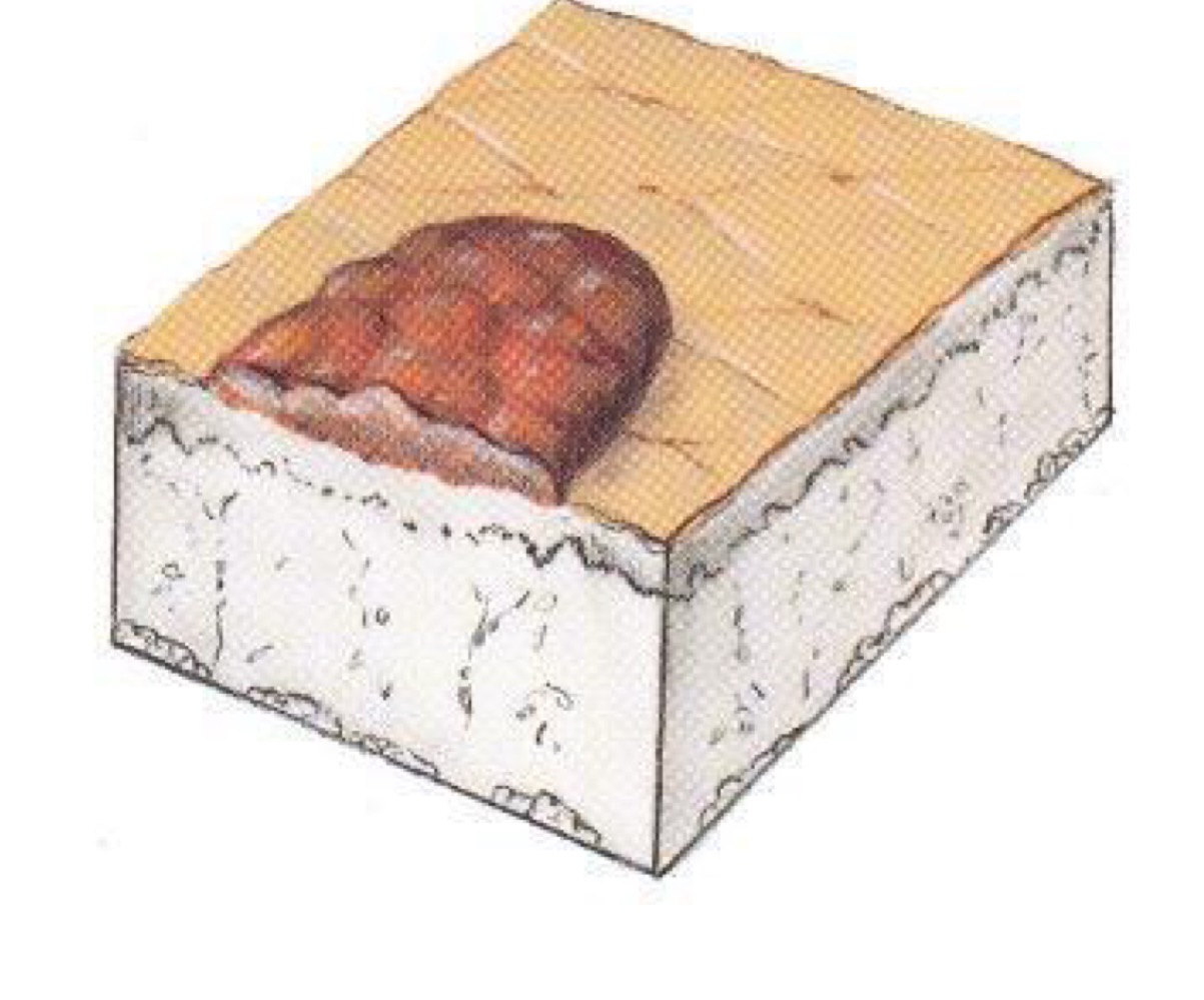 <p>what type of skin lesion is this? </p>