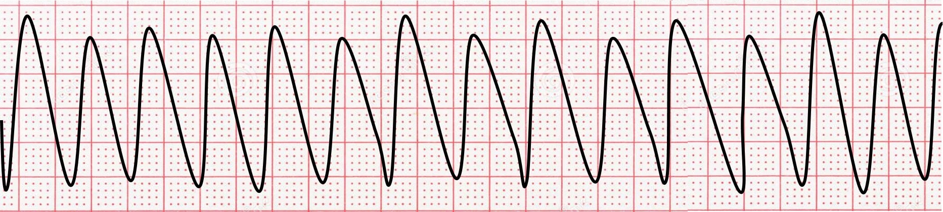 <p>name  ECG pattern</p>