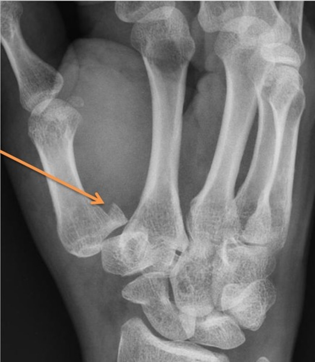 <p>Fracture at base of first metacarpal</p>