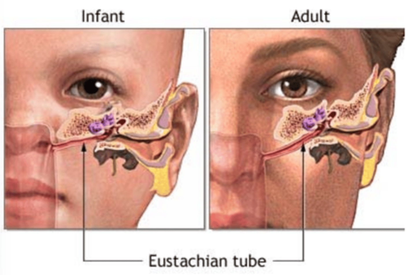 <p>Anatomy = kids’ Eustachian tubes are: </p><p>• Shorter </p><p>• More horizontal </p><p>• Narrower</p><p>Physiology: kids immune systems haven’t yet seen or developed antibodies to many of the viruses and bacteria that cause otitis media</p>