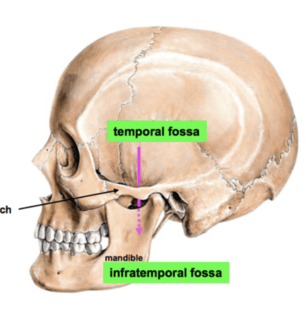 <p>above the zygomatic arch</p>