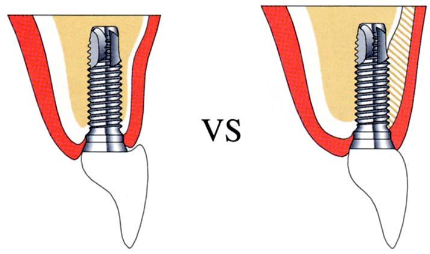 <p>Ideally in the same position where the missing tooth was</p>