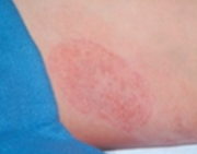 <p>papules coalescing by superficial thickening of the epidermis</p>