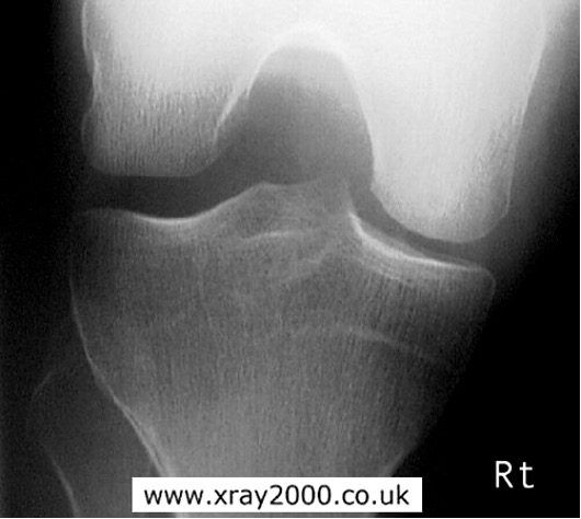 <p>tibial spines and femoral condyles</p>