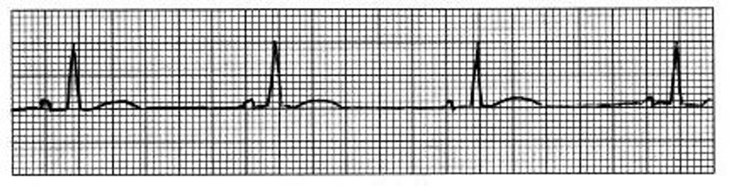 <p>Slow heart rate; &lt;60bpm</p>