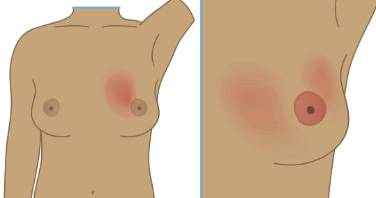 <p><strong>Mastitis</strong></p>