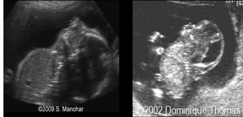 <p>an abnormally <strong>shor</strong>t fetal <strong>neck </strong>w/<strong>fixed posterior flexion</strong> is called</p><p>.</p><p>a) lissencephaly [smooth cerebral tissue - no sulci or gyri] </p><p>b) scoliosis</p><p>c) schizencephaly [abn clefting of cerebral tissue]</p><p>d) iniencephaly</p>