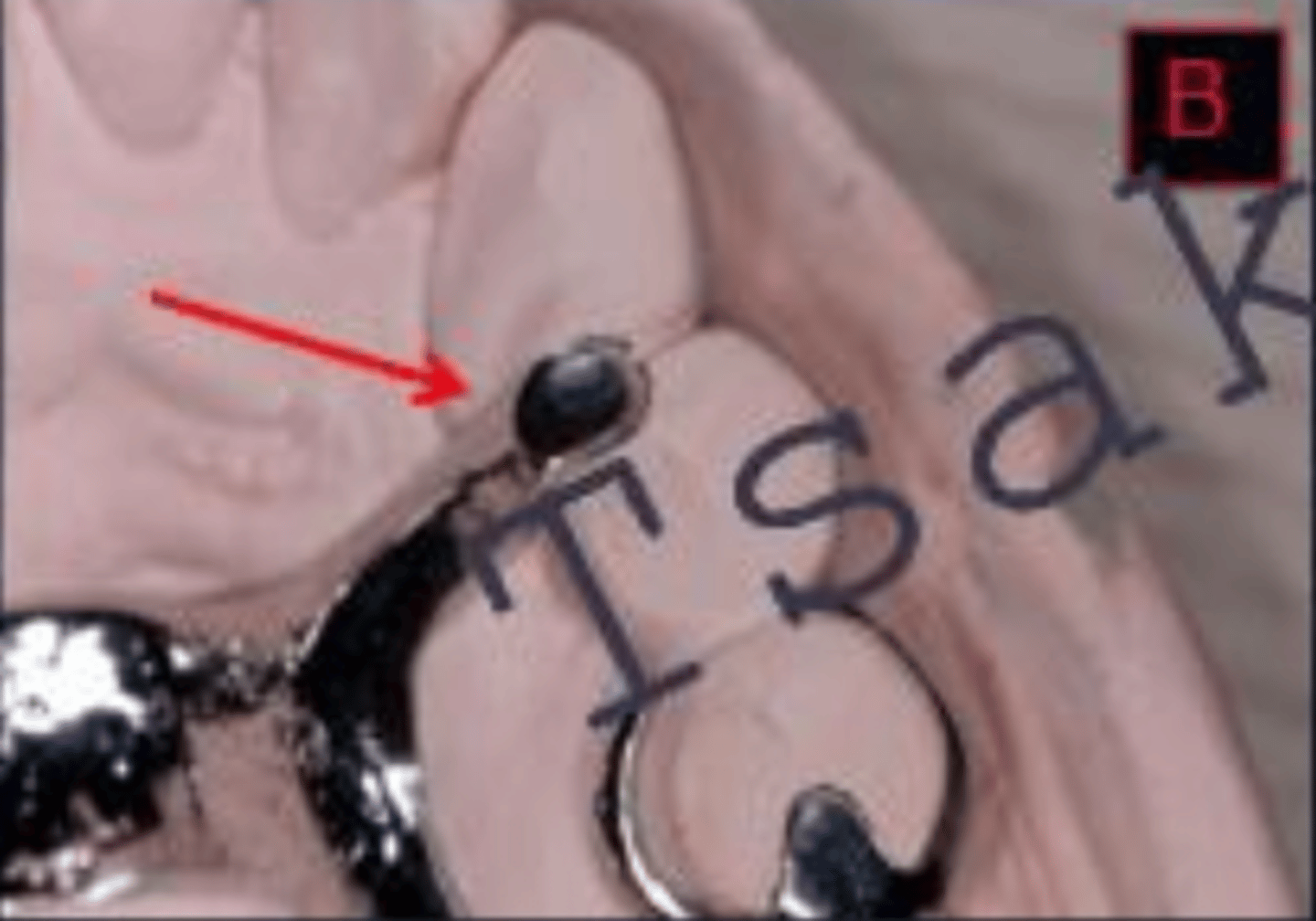 <p>When checking an RPD returned from the lab, the rest should be a minimum of ___mm at the junction</p>