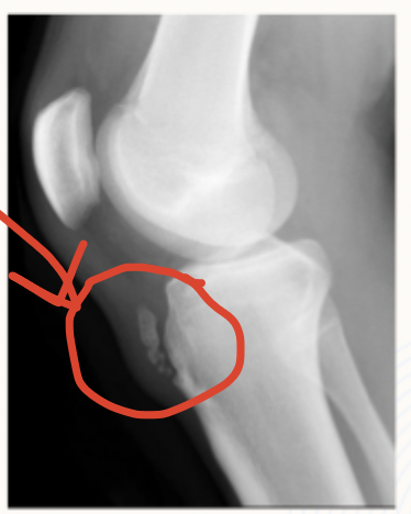 <p>14 y/o male presents to the clinic for knee pain that is worse with kneeling and resisted knee extension. He points to the anterior aspect of the proximal tibia when you ask him where the pain is. The tubercle is tender and enlarged. Xrays show irregularity and fragmentation of the tibial tubercle. What is your treatment plan?</p>