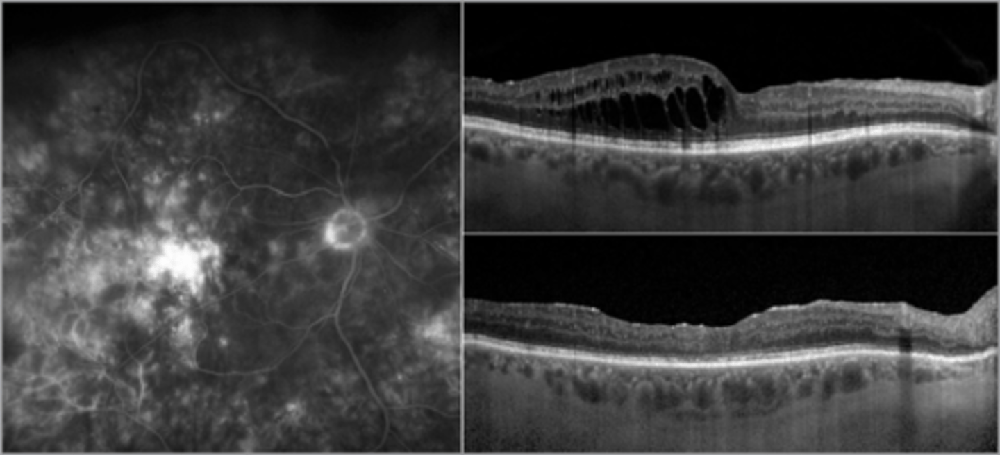 <p>most cases are self-limiting (&lt;3-4 mos) = vision improves</p>