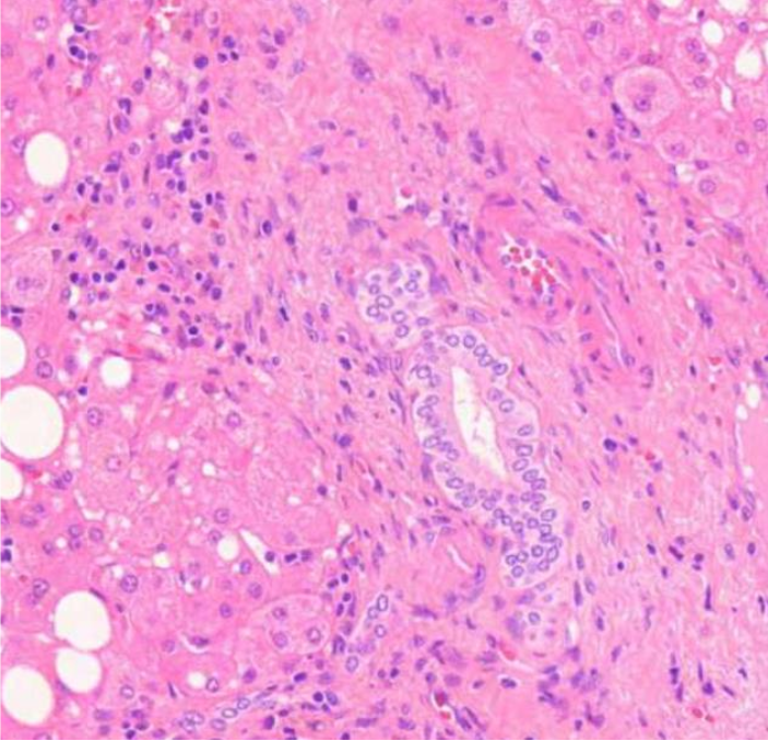 <p><strong><u>MIKÄ TAUTI? </u></strong>Portaali-alueella nähdään tulehdussolukertymää ja sidekudoslisää</p>