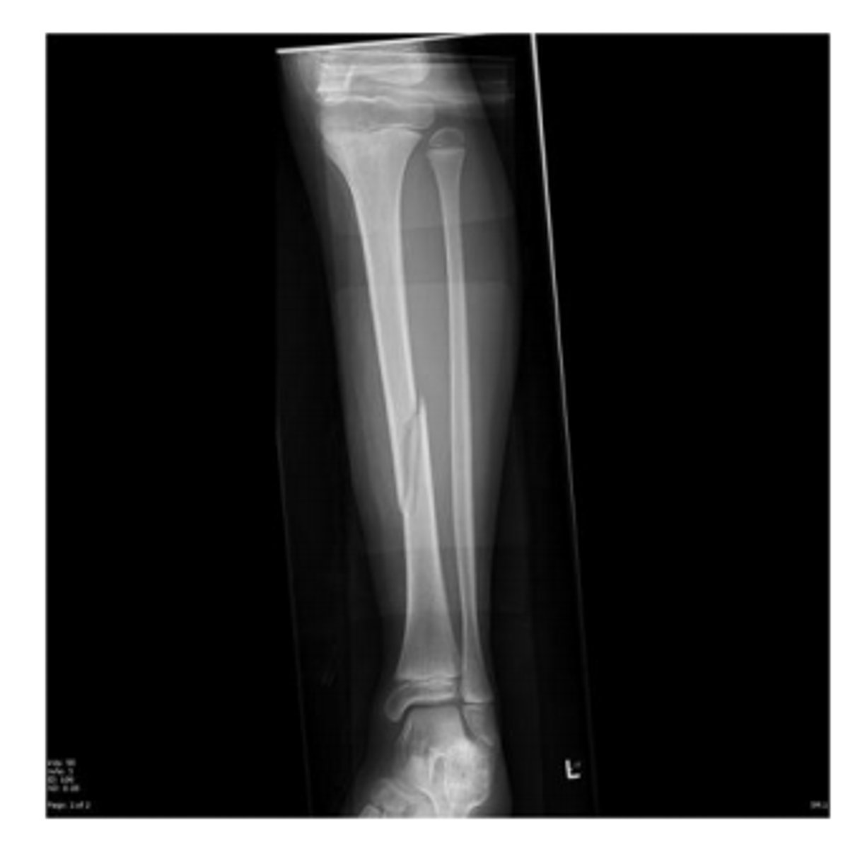 <p>Oblique fracture</p>