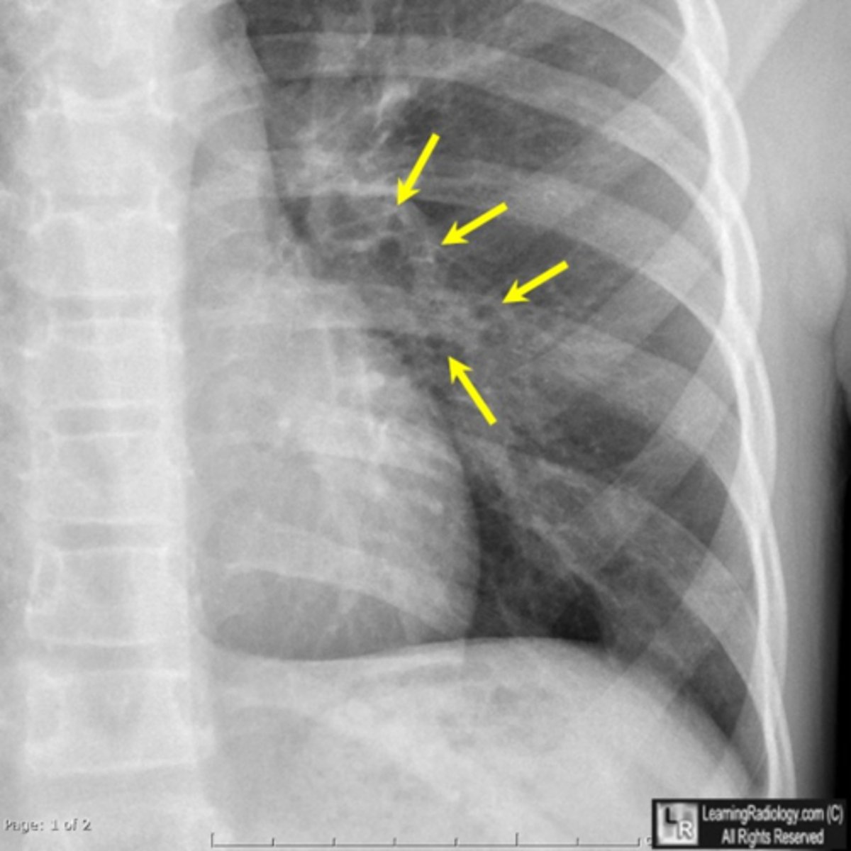 <p>Bone fusion is the best predictor of age.</p>