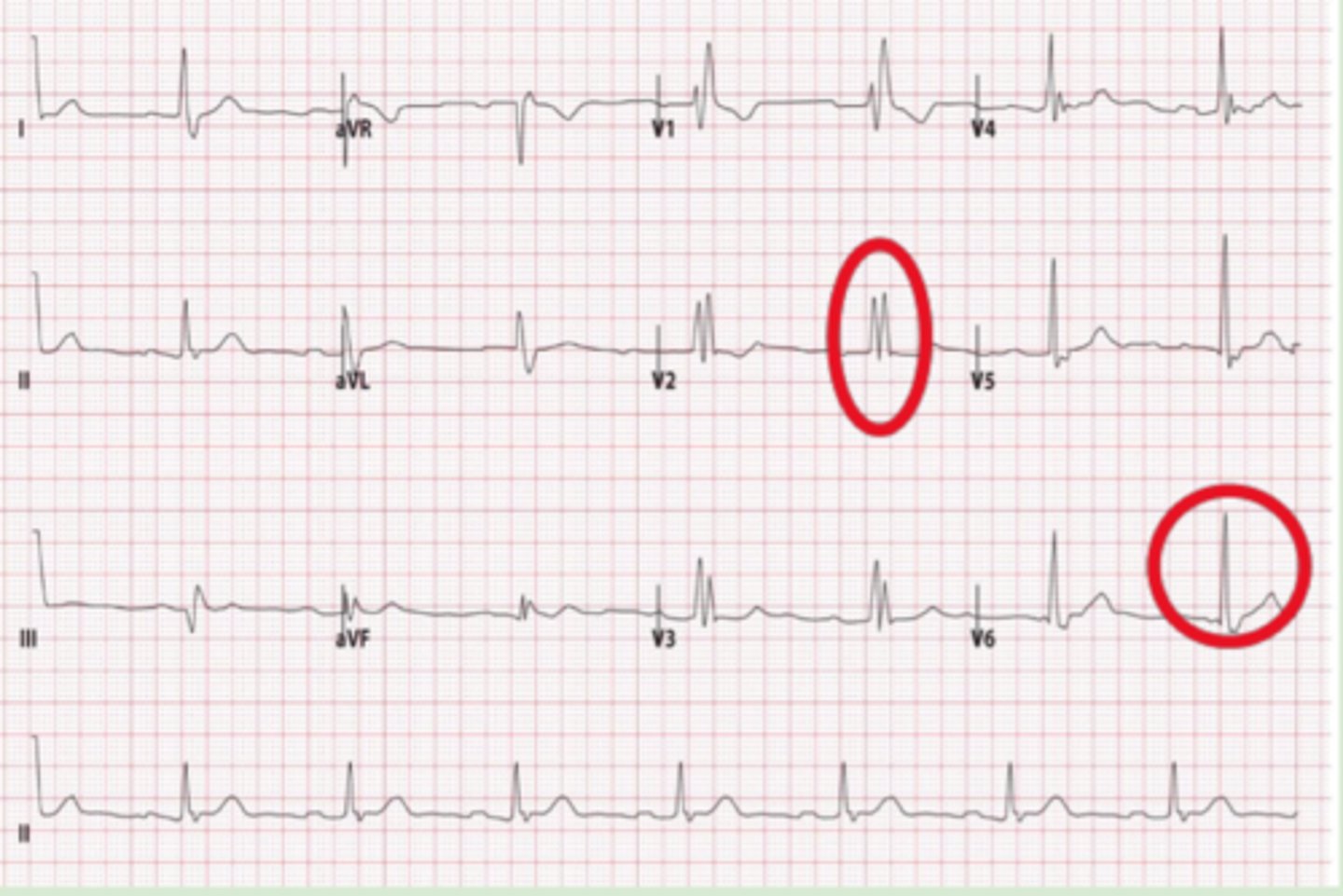 <p>QRS = &gt;0.12 seconds</p><p>Primarily V1 but also V2-V3</p><p>-RSR appearance (M wave)</p><p>V5-V6</p><p>-Wide, slurred s wave</p>