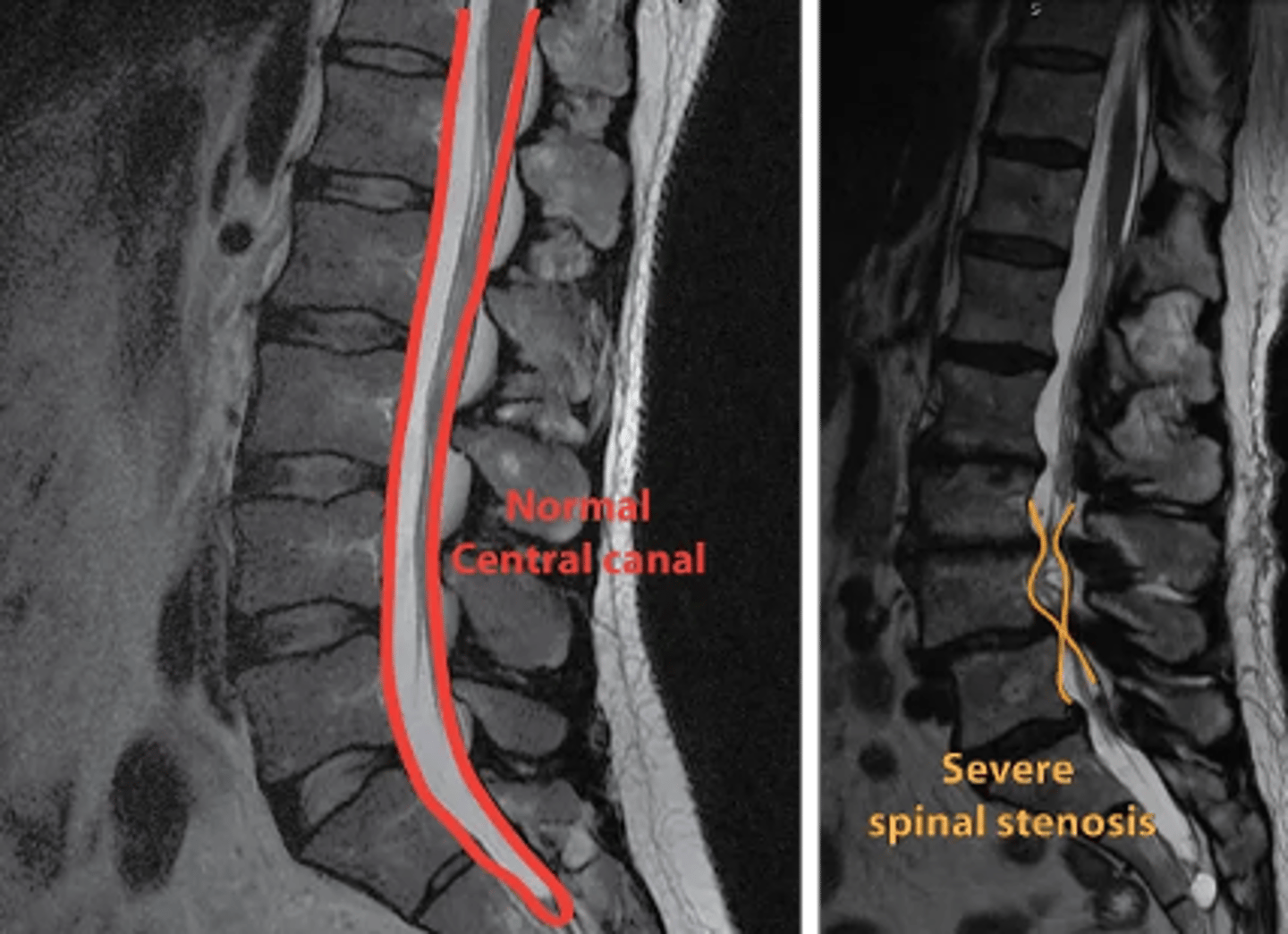 <p>Xray</p><p>•Nonspecific arthritic changes (disk space narrowing, osteophyte formation)</p><p>•Degenerative scoliosis</p><p>•Degenerative spondylolisthesis hypertrophy</p><p>CT Myelogram</p><p>•If MRI is contraindicated (pacemaker, metallic implants)</p>