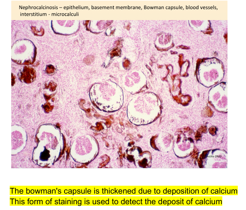 <p><strong>Nephrocirrhosis (Van Koss)</strong></p>