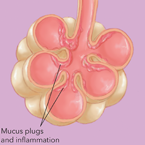 <p>Type of COPD where <span><span>the bronchiole lining becomes inflamed, and excess mucus forms, obstructing airflow. The cilia, which clear mucus, are damaged.</span></span></p>