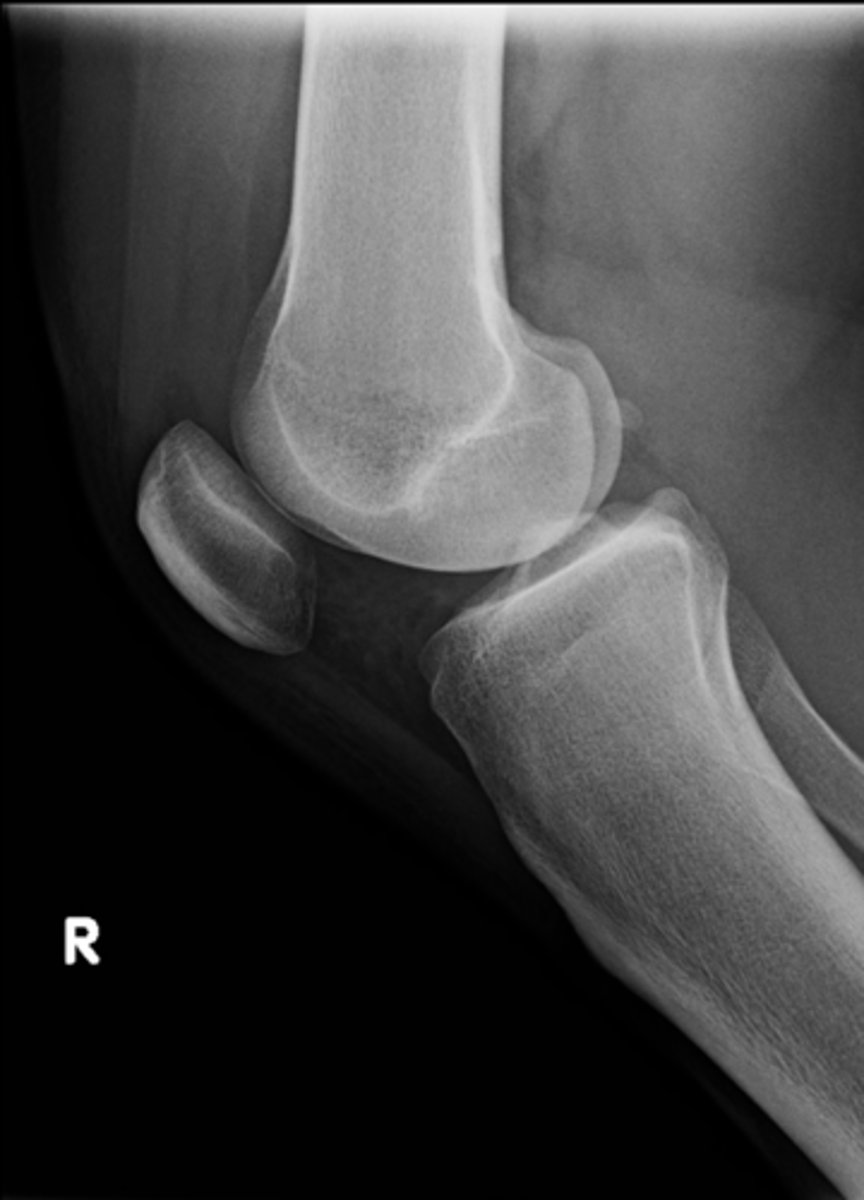 <p>Lateral knee projections are generally taken with _____</p>