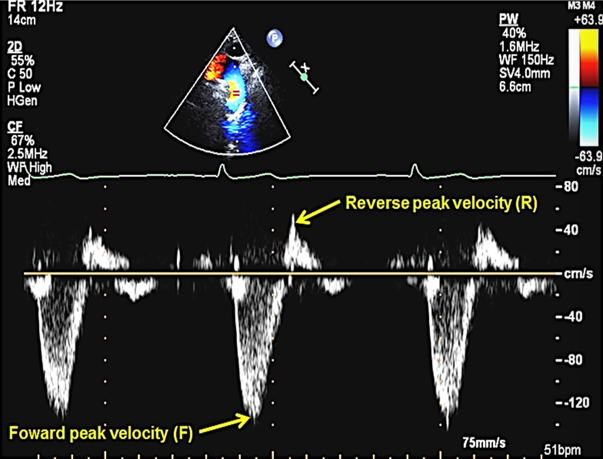 <p>taken at subcostal and SSN</p><p>look for evidence of holodiastolic flow reversal ( should not see SUSTAINED flow reversal thorugh diastole in aorta → severe regurg)&nbsp;</p><img src="https://knowt-user-attachments.s3.amazonaws.com/25a02db9-863d-4229-98c7-1e657731123f.png" data-width="100%" data-align="center"><p></p>