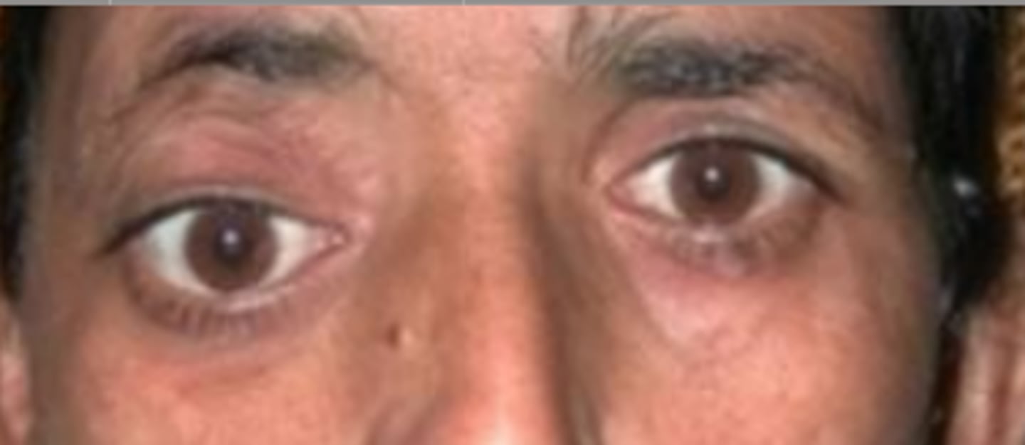 <p>a vertical misalignment of the orbit which can be congenital (craniosynostosis) or acquired via trauma or mass of the orbit.</p>