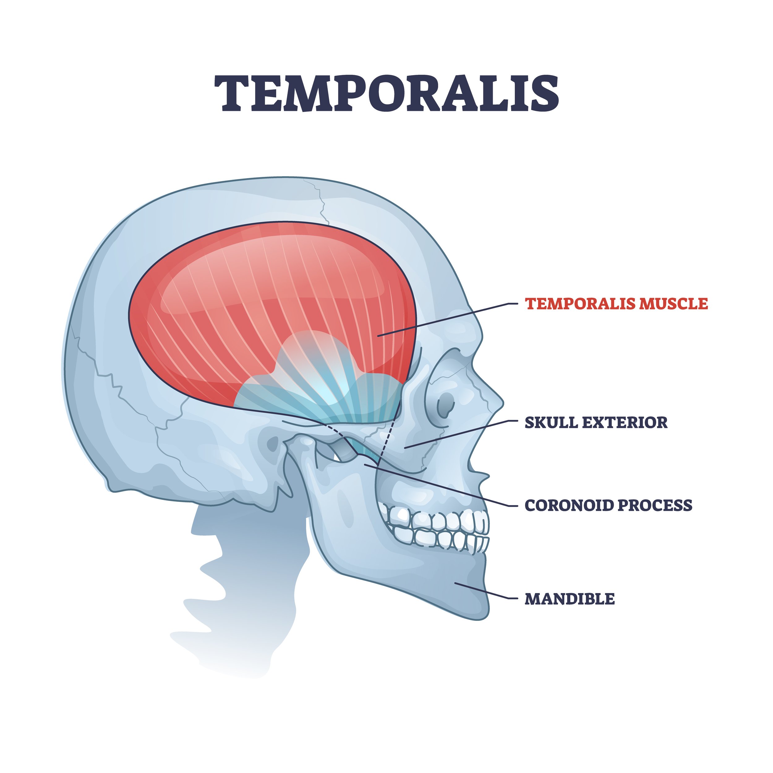 <p><strong>Origin</strong></p><p><span>Temporal fossa &amp; deep surface of temporal fascia</span></p><p><strong>Insertion</strong></p><p><span>Tip &amp; medial surface of coronoid process &amp; ramus of mandible</span></p><p><strong>Peripheral Innervation</strong></p><p>Mandibular Division of Trigeminal Nerve (CN V3)</p><p><strong>Segmental Innervation</strong></p><p>Mandibular Division of Trigeminal Nerve (CN V3)</p><p><strong>Action</strong></p><p>Elevates mandible; posterior fibers retrude mandible after protrusion</p>