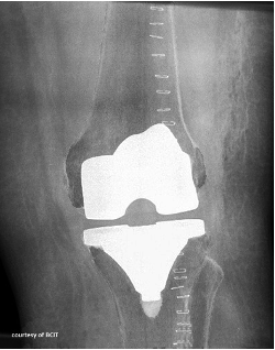 <p>Joint Replacement</p>