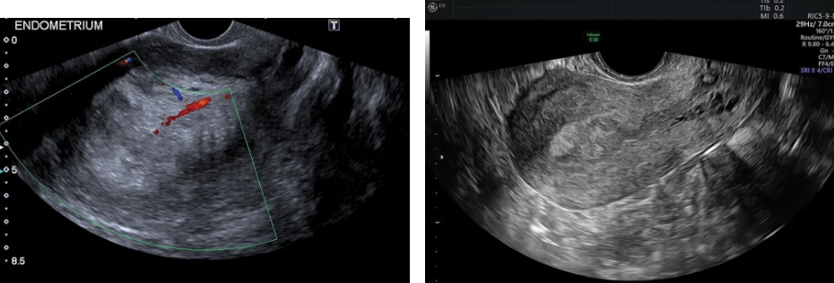 <p><strong><em>___________is the most common gynecologic malignancy in North America</em></strong>, and its</p><p class="p1">incidence has been rising.</p><p class="p1"> <strong><em>Most endometrial malignancies are adenocarcinomas </em></strong>occurring in postmenopausal patients.</p><p class="p1"> The <strong><em>most common clinical presentation is uterine bleeding</em></strong>, although only 10% of women with</p><p class="p1"><strong><em>postmenopausal bleeding </em></strong>will have endometrial carcinoma.</p><p class="p1"> There is a <strong>strong association with replacement estrogen therapy</strong>.</p><p class="p1"> In the premenopausal woman, <strong><em>anovulatory cycles </em></strong>and <strong><em>obesity are also considered risk factors</em></strong>.</p><p class="p1"> The <strong><em>earliest change of endometrial carcinoma is a thickened endometrium</em></strong>. An <em>abnormally thick</em></p><p class="p1"><em>endometrium is also associated with endometrial hypertrophy and polyps.</em></p><p class="p1"> Although increased endometrial thickness is an early finding in endometrial carcinoma,</p><p class="p1">enlargement with <strong>lobular contour of the uterus and mixed echogenicity </strong>are correlated with</p><p class="p1"><strong>more advanced stages of the disease</strong>. The <strong>risk of malignancy increases with the presence of a</strong></p><p class="p1"><strong>large endometrial fluid collection or clinical symptoms, such as abdominal pain or bleeding</strong>.</p><p class="p1"> Endometrial carcinoma may obstruct the endometrial canal, resulting in hydrometra or hematometra.</p><p class="p1"> The level of myometrial invasion (superficial versus deep) also can be detected by transvaginal ultrasonography, although</p><p class="p1"><strong><em>contrast-enhanced MRI is more sensitive</em></strong>. MRI is also valuable in evaluating extrauterine extension and involvement of</p><p class="p1">lymph nodes.</p><p class="p1"> <strong><em>Tamoxifen</em></strong>, a nonsteroidal antiestrogen compound, is widely used for adjuvant therapy in premenopausal and</p><p class="p1">postmenopausal women with breast cancer and <strong><em>has secondary effects on the endometrium</em></strong>.</p><p class="p1"> An increased risk of endometrial carcinoma, hyperplasia, and polyps has been reported in patients on tamoxifen therapy. On</p><p class="p1">sonography, tamoxifen-related endometrial changes are nonspecific and similar to those described in hyperplasia, polyps, and</p><p class="p1">carcinoma. Because it may be difficult to distinguish the endometrial-myometrial border in many of these patients,</p><p class="p1">sonohysterography is valuable.</p><p class="p1"> Sonography may be helpful in staging carcinoma and in distinguishing between tumors limited to the uterus (stages I and II)</p><p class="p1">and those with extrauterine extension (stages III and IV). Both MRI and CT are useful in staging by demonstrating</p><p class="p1">lymphadenopathy and distant disease (stages III or IV). <strong><em>Endometrial biopsy is usually required for a definite diagnosis.</em></strong></p><p class="p1">Sonographic Findings</p><p class="p2"> <strong><em>Transvaginal examination is helpful in screening for early changes of endometrial hyperplasia or carcinoma</em></strong></p><p class="p2"><strong><em>by accurately measuring endometrial thickness.</em></strong></p><p class="p2"> Sonographically, a <strong>thickened endometrium </strong>(greater than 4 to <strong>5 mm</strong>, and this value varies institution to</p><p class="p2">institution) <strong>should be considered cancer </strong>until proven otherwise.</p><p class="p2"> Demonstration of <em>myometrial invasion is clear evidence for endometrial carcinoma</em>.</p><p class="p2"> Transvaginal ultrasonography demonstrates myometrial invasion as thickening and irregularity of the central</p><p class="p2">endometrial interface with echogenic or hypoechoic patterns combined with infiltration of hyperdense structures</p><p class="p2">in the myometrium.</p><p class="p2"> <em>Cystic changes within the endometrium are more commonly seen in endometrial atrophy, hyperplasia, and polyps</em></p><p class="p2"><em>but can also be seen with carcinoma</em>.</p><p class="p2"> Endometrial masses containing numerous vascular branches with color imaging should also raise the level of</p><p class="p2">suspicion for carcinoma.</p>