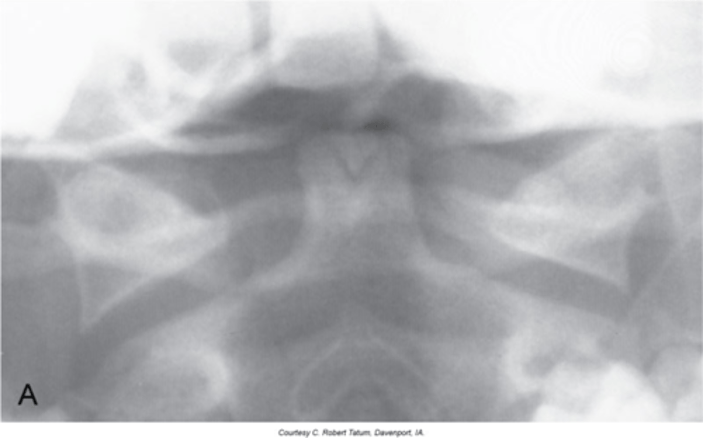 <p>Clinical significance of Os Terminale (of Bergmann)</p>