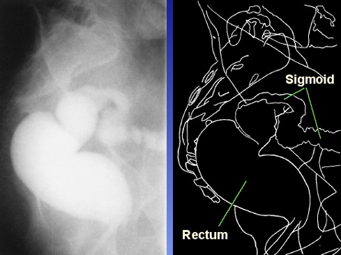 <p>What is this x-ray demonstrating?</p>