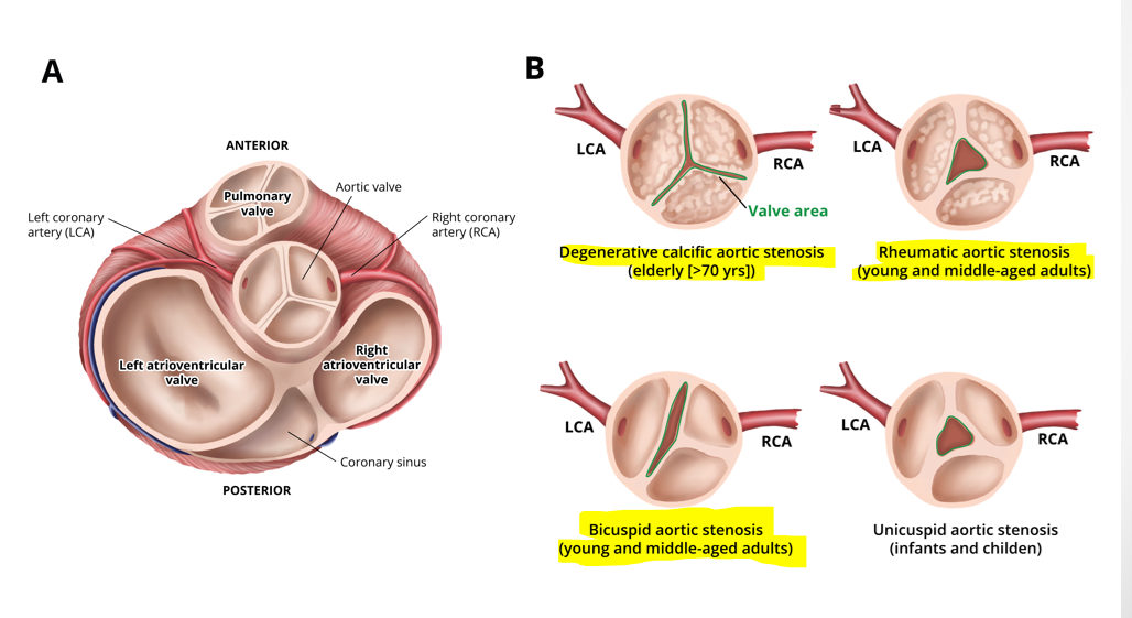 <p>degenerative calcific aortic stenosis (elderly &gt;70)</p><p>bicuspid aortic stenosis (young/middle aged)</p><p>rheumatic aortic stenosis (young/middle aged) </p>