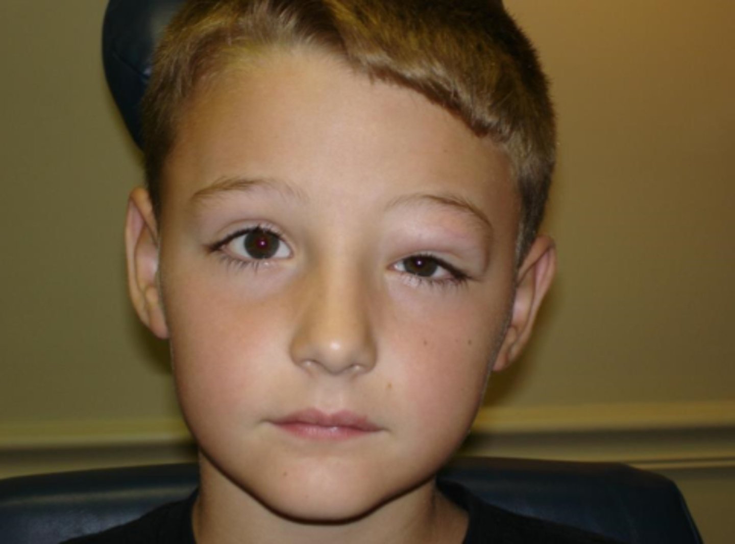<p>paralytic strabismus</p><p>TED = infiltration restrains eye movement</p><p>orbital tumors push on eye</p><p>orbital inflam </p>