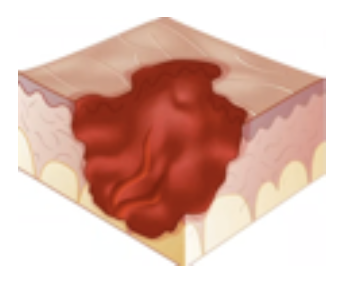 <p>Secondary Skin Lesion</p><ul><li><p><strong>Deeper</strong> than erosion with many stages</p></li><li><p>Can extend to the <strong>bones</strong></p></li><li><p>E.g., pressure __, advanced stage</p></li></ul><p></p>