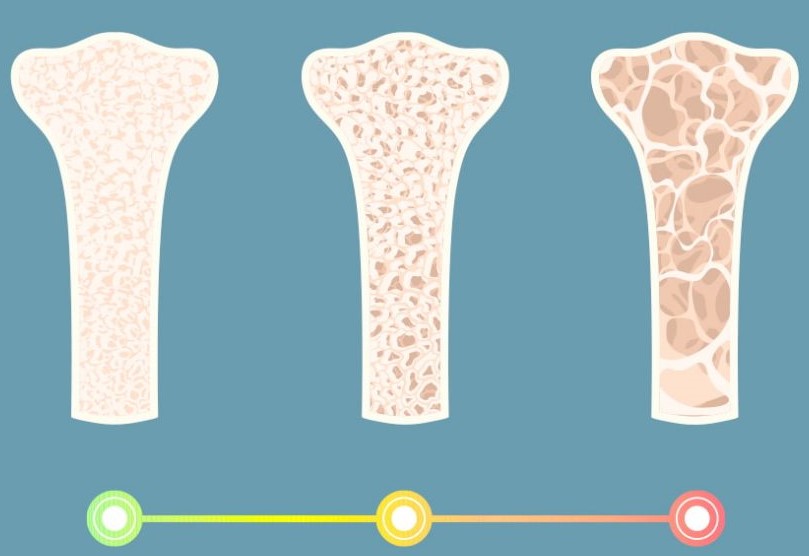 a condition in which the bones lose density and become fragile and break easily. most common in elderly (disuse),post-injury (disuse), females (esp. Caucasians)

